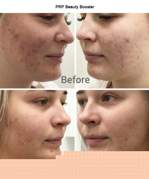East ham Hair loss treatment