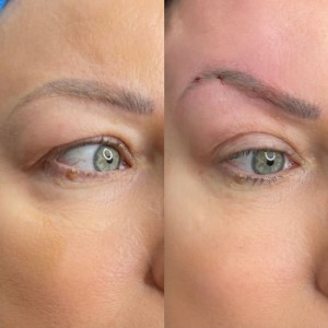 Pdo threadlift The east end