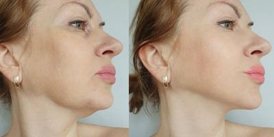 Wapping Pdo threadlift